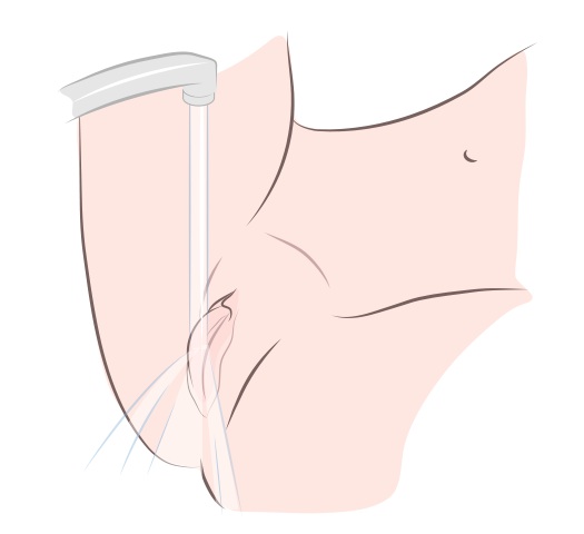 Ilustração mostrando o jato de água direcionado à vulva